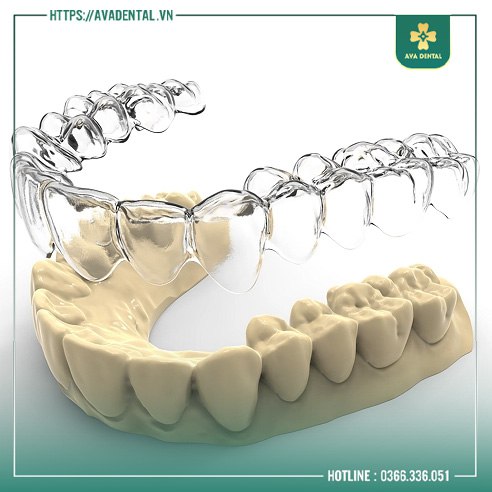 NIỀNG RĂNG TRONG SUỐT CÓ HIỆU QUẢ KHÔNG? 12 niềng răng trong suốt