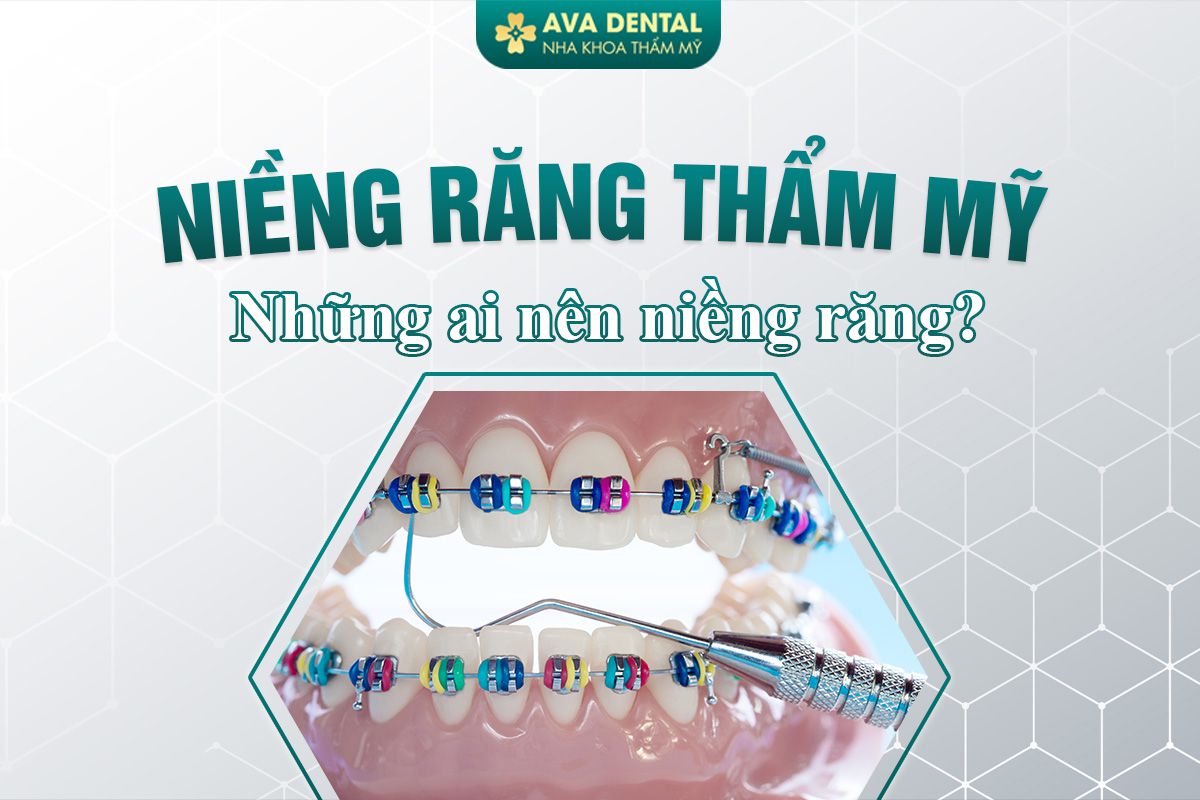 Niềng Răng Thẩm Mỹ Là Gì? Những Ai Nên Niềng Răng? 8 niềng răng thẩm mỹ