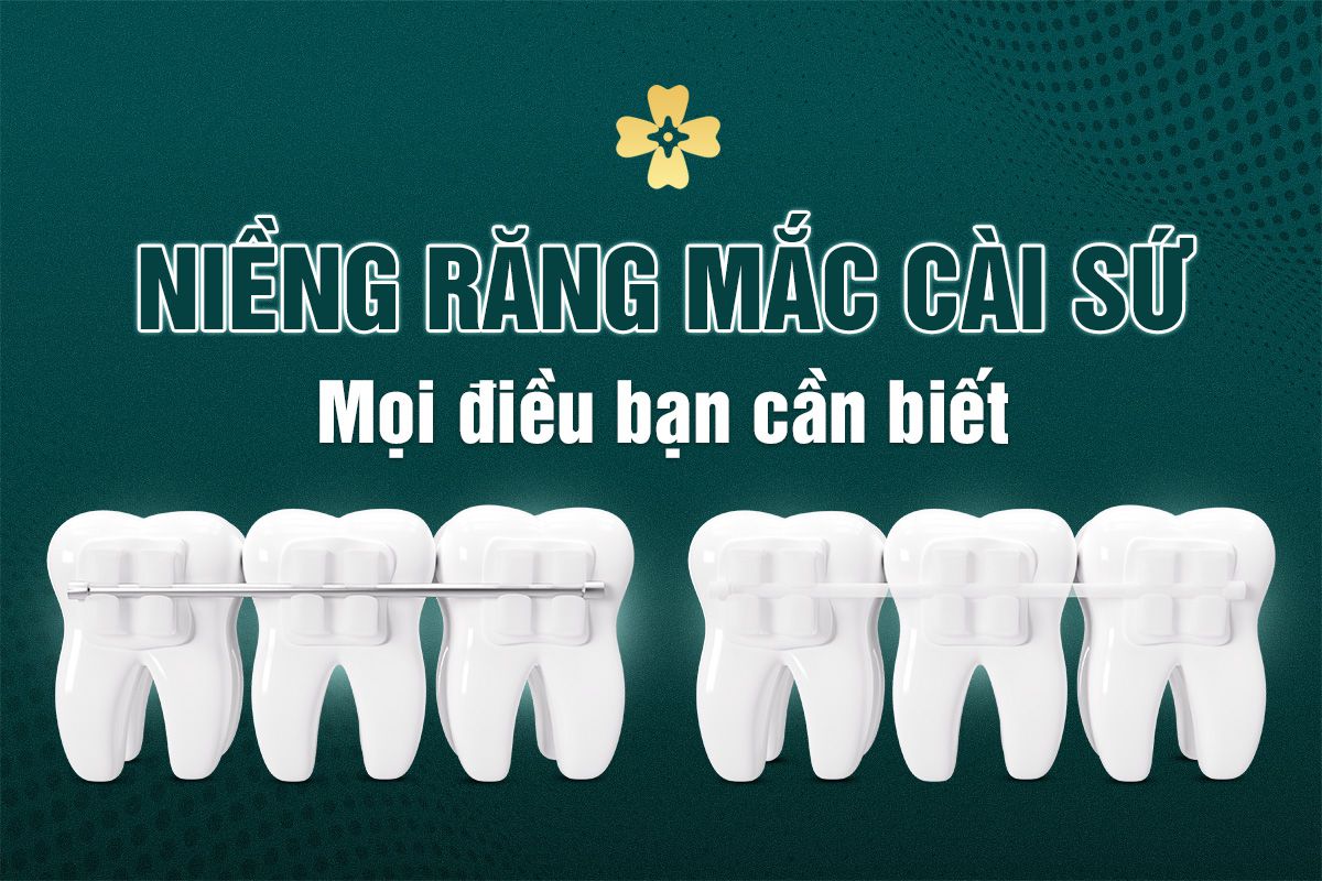 niềng răng mắc cài sứ thẩm mỹ