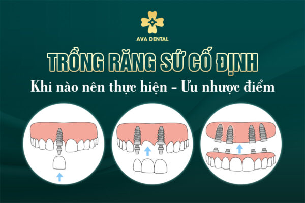RANG SU CO DINH
