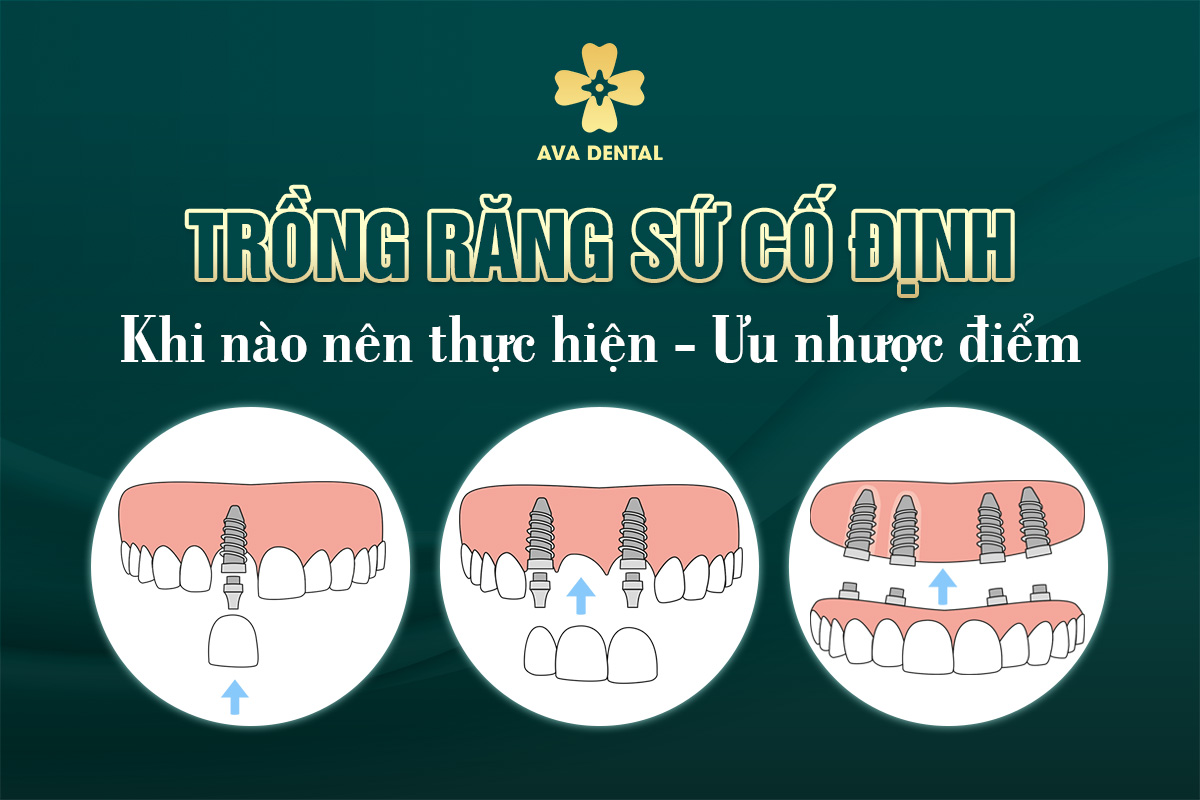 trồng răng sứ cố định
