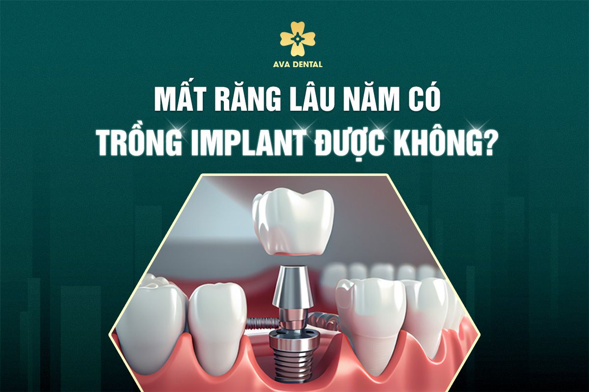 Mất Răng Lâu Năm Có Trồng Implant Được Không? 8 mất răng lâu năm có trồng implant được không