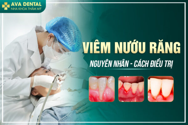 VIEM NUOU RANG