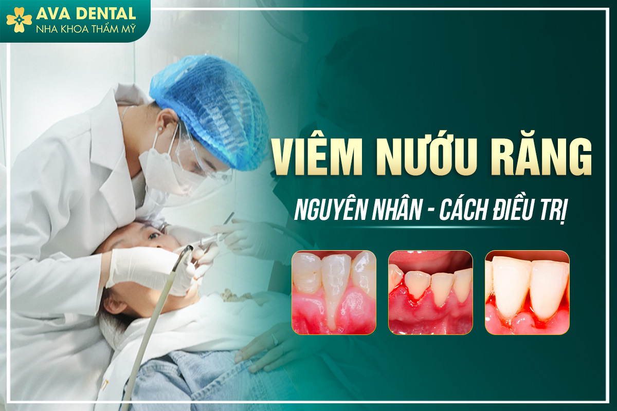 viêm nướu răng