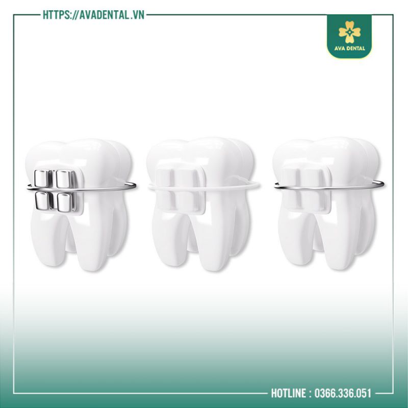 niềng răng o dau tot nhat tphcm