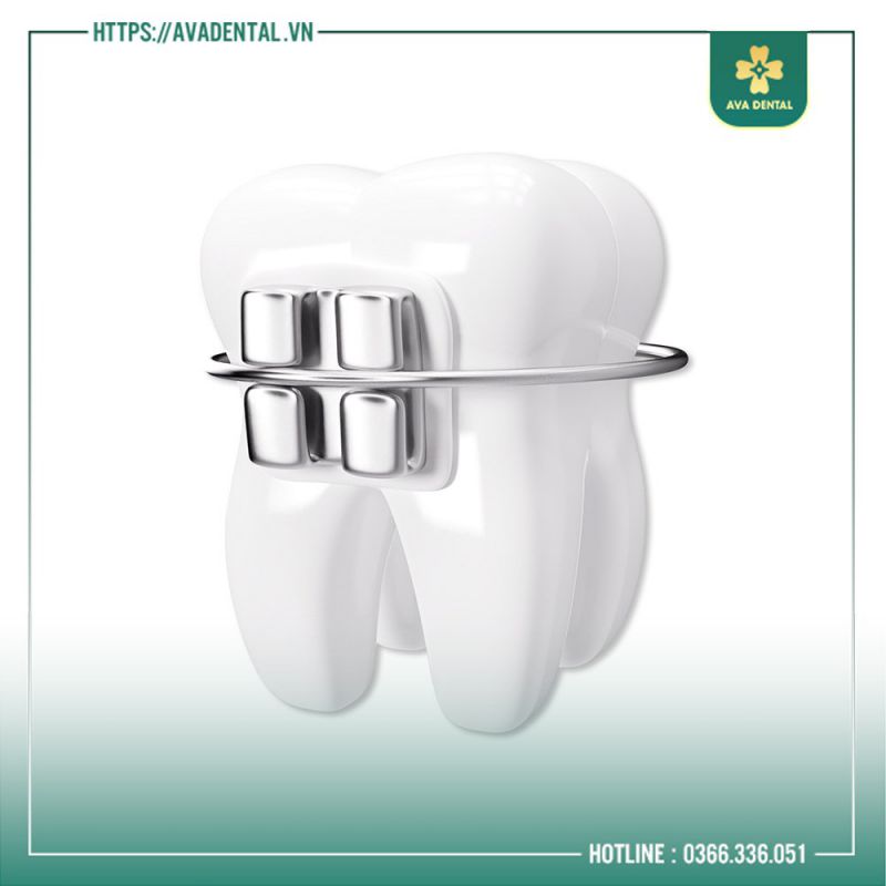 nha khoa nào niềng răng tốt ở tphcm