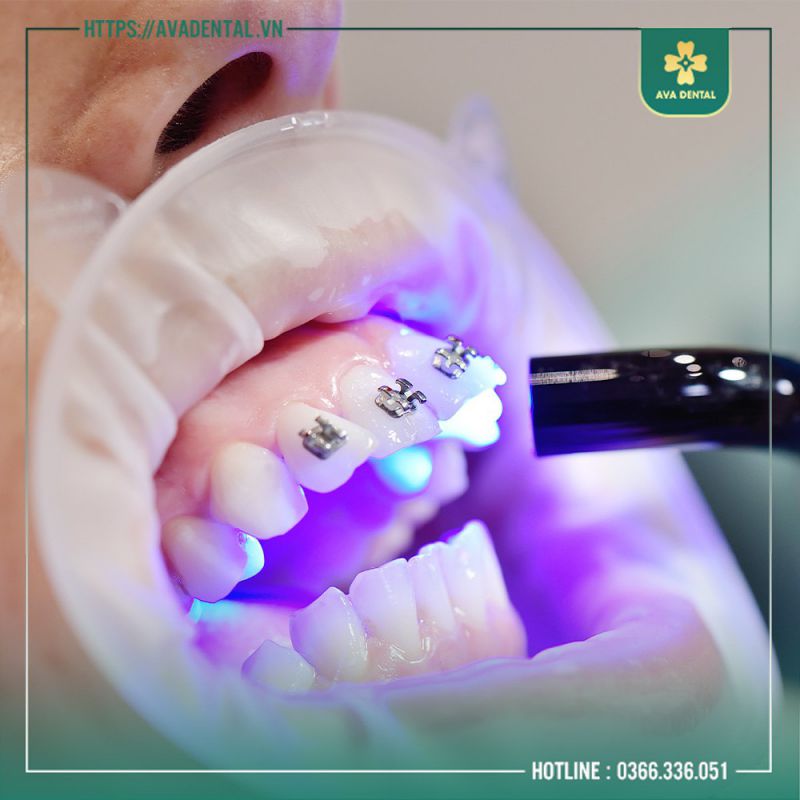 Niềng Răng Thẩm Mỹ Là Gì? Những Ai Nên Niềng Răng? 9 photo 8 2024 03 14 15 32 58