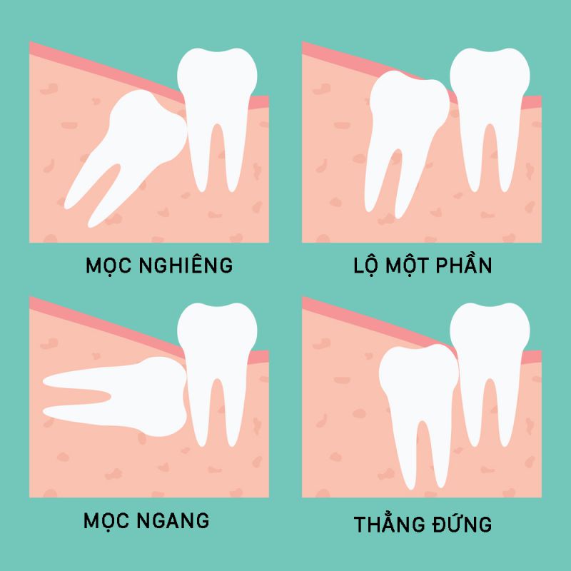răng số 8