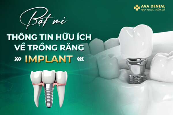 Bat mi thong tin Implant
