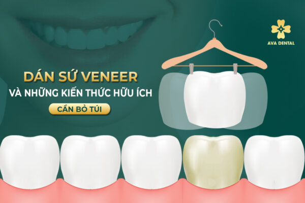 Dan su Veneer 1