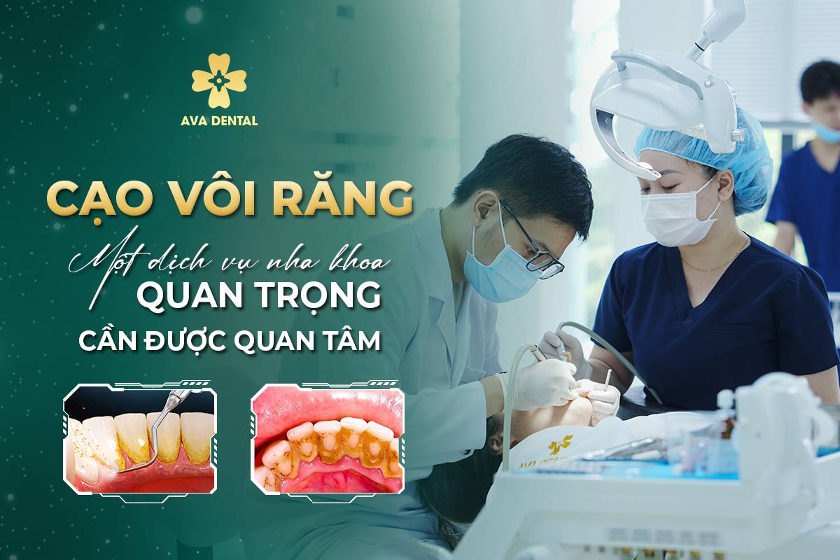 cạo vôi răng