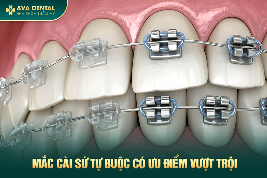 Mắc Cài Sứ Tự Buộc Là Gì? Chi Phí Niềng Răng Mắc Cài Tự Buộc Giá Tốt Tại TP.HCM 17 1 3