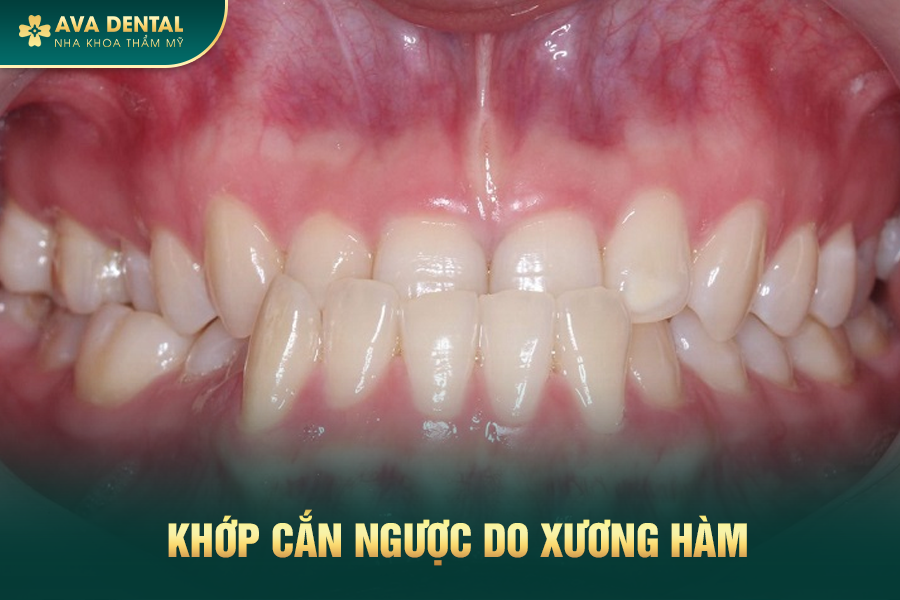 Khớp Cắn Ngược Là Gì? Chi Phí Niềng Răng Khớp Cắn Ngược Giá Tốt 14 1 4