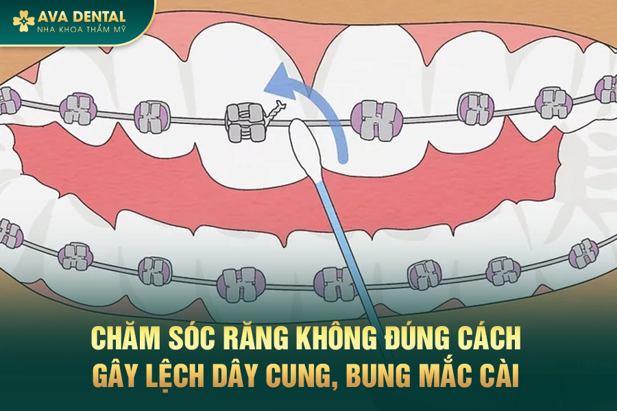Có Nên Niềng Răng Lần 2 Không? Giá Bao Nhiêu? Ở Đâu Uy Tín Tại TP.HCM 13 1 7