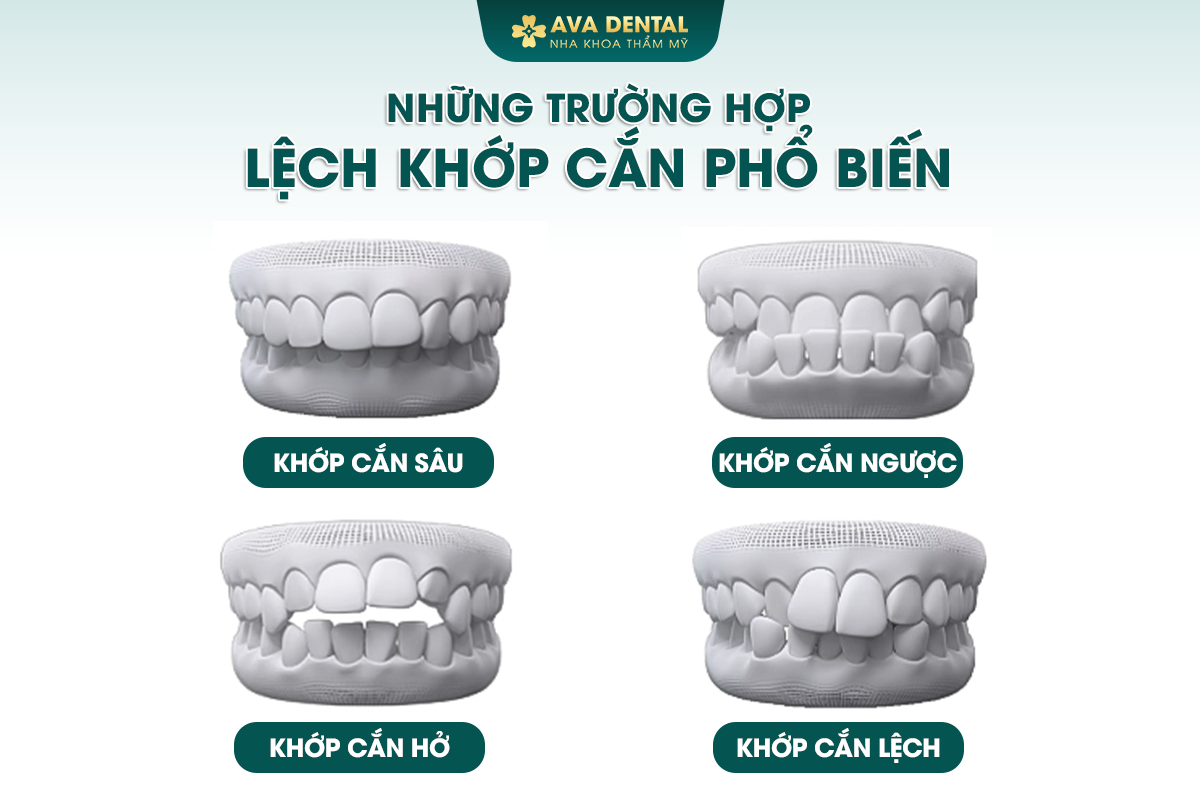 Khớp Cắn Lệch Là Gì? Chi Phí Niềng Khớp Cắn Lệch Giá Tốt Tại TP.HCM 14 14
