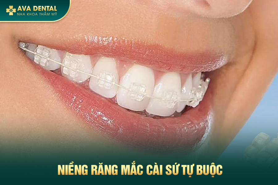 Mắc Cài Sứ Tự Buộc Là Gì? Chi Phí Niềng Răng Mắc Cài Tự Buộc Giá Tốt Tại TP.HCM 15 182