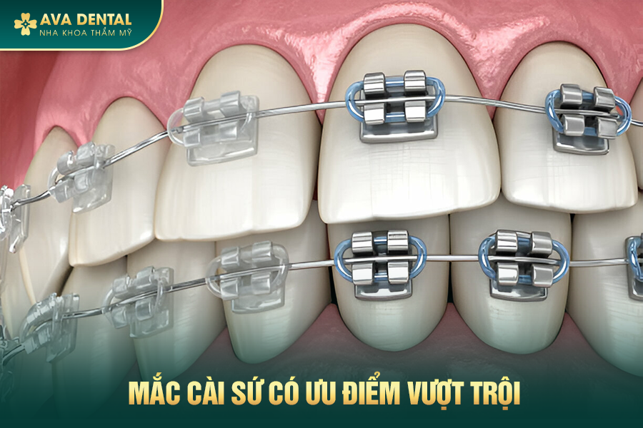 Chi Phí Niềng Răng Mắc Cài Sứ Bao Nhiêu 2024? 14 2 2