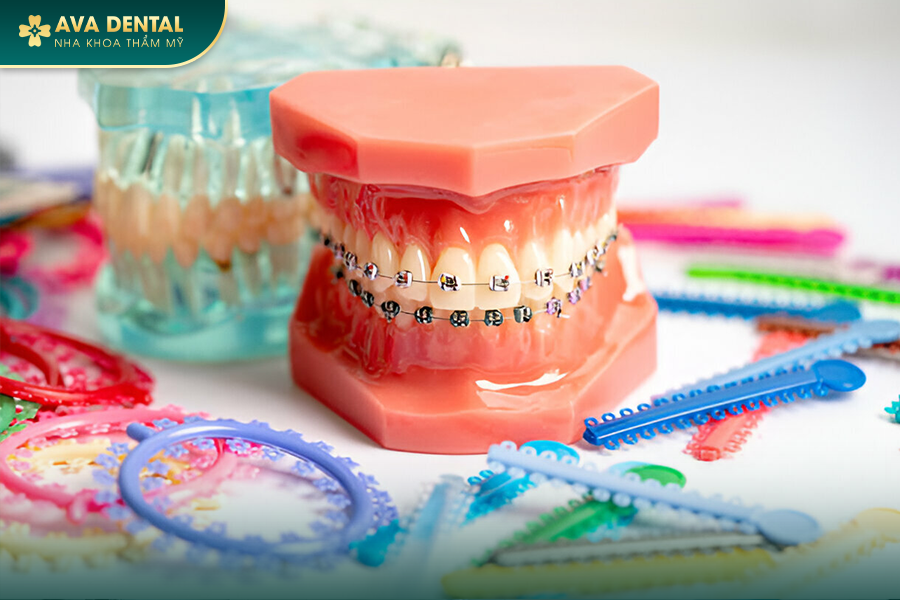 Niềng Răng Mắc Cài Là Gì? Phân Loại Và Báo Giá Tốt Nhất Tại TP.HCM 13 2 3