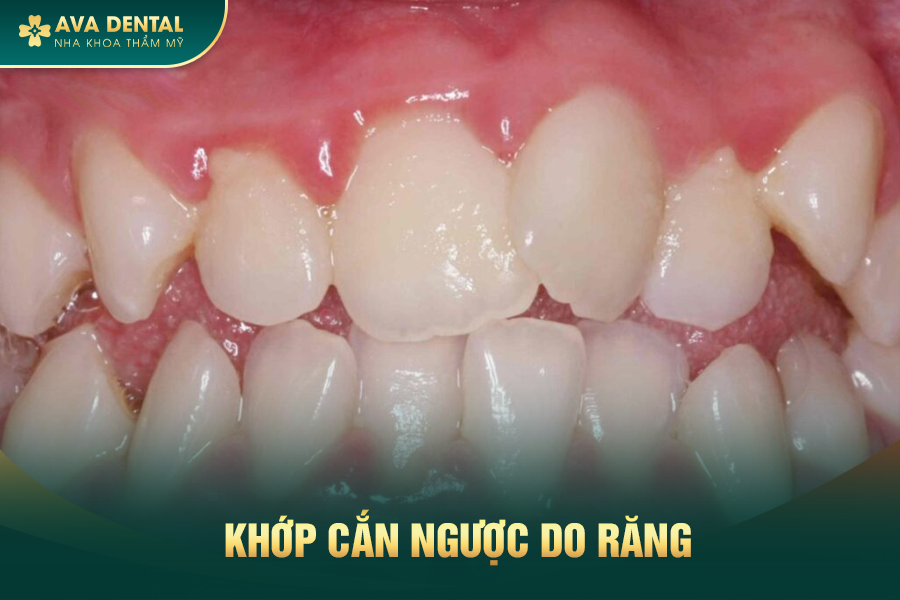Khớp Cắn Ngược Là Gì? Chi Phí Niềng Răng Khớp Cắn Ngược Giá Tốt 15 2 5