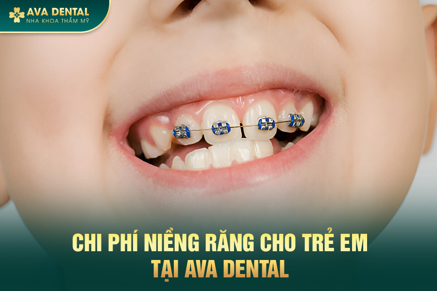 Niềng Răng Cho Trẻ Em: Độ Tuổi Và Chi Phí Bao Nhiêu 2024? 24 2222
