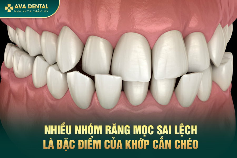 Khớp Cắn Chéo Là Gì? Chi Phí Niềng Răng Khớp Cắn Chéo Mới Nhất 2024 17 307