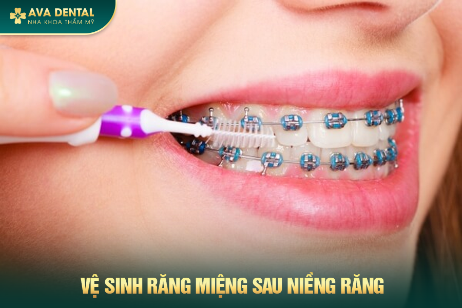 Chi Phí Niềng Răng Mắc Cài Sứ Bao Nhiêu 2024? 16 369