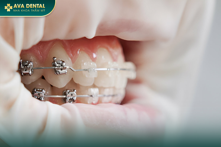 Niềng Răng Mắc Cài Là Gì? Phân Loại Và Báo Giá Tốt Nhất Tại TP.HCM 14 4 4