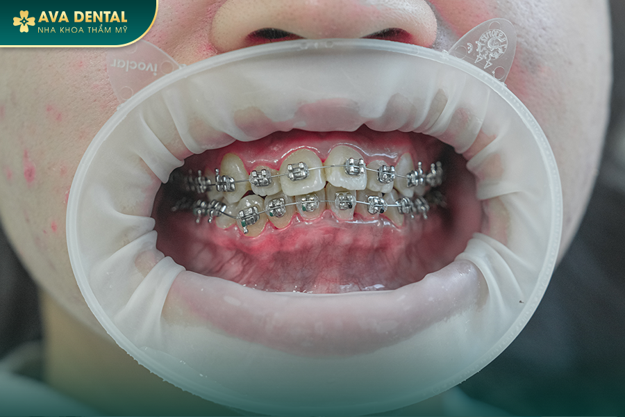 Mắc Cài Kim Loại Tự Buộc Là Gì? Chi Phí Niềng Răng Mắc Cài Tự Buộc Giá Tốt TP.HCM 19 6