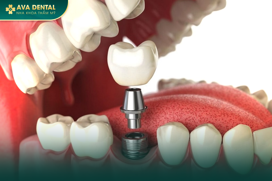 bang gia trong rang implant 1