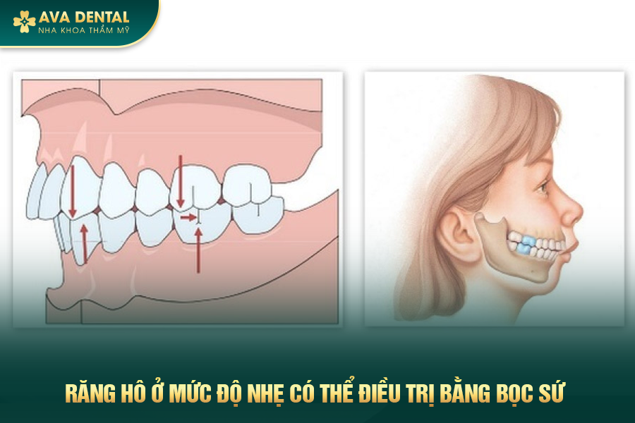 Bọc Răng Sứ Cho Răng Hô Là Gì? Chi Phí Bao Nhiêu 2024 18 boc rang su cho rang ho 1