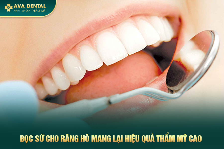 Bọc Răng Sứ Cho Răng Hô Là Gì? Chi Phí Bao Nhiêu 2024 20 boc rang su cho rang ho 2