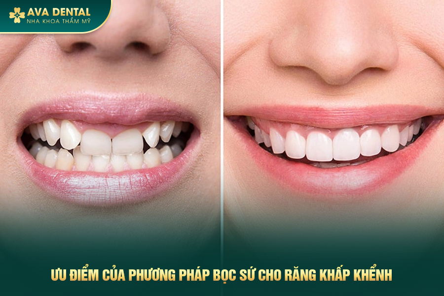 Bọc Răng Sứ Cho Răng Khấp Khểnh Là Gì? Chi Phí Bao Nhiêu 2024 18 boc rang su cho rang khap khenh 3