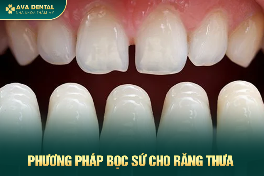 Bọc Răng Sứ Cho Răng Thưa Là Gì? Chi Phí Bao Nhiêu 2024 14 boc rang su cho rang thua 1