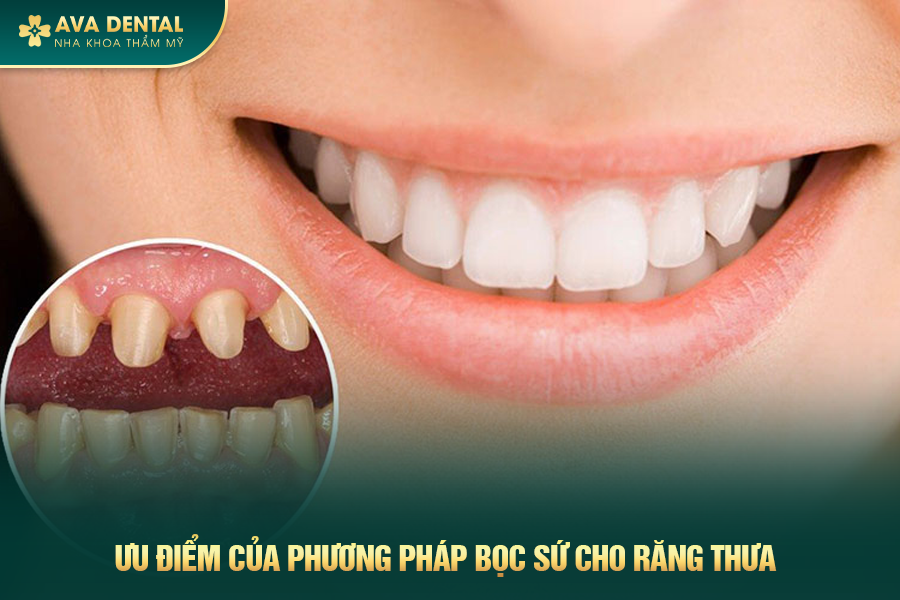 Bọc Răng Sứ Cho Răng Thưa Là Gì? Chi Phí Bao Nhiêu 2024 16 boc rang su cho rang thua 2