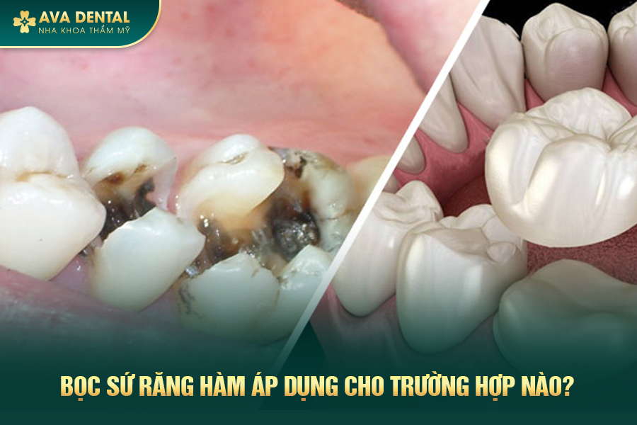 Bọc Răng Sứ Cho Răng Hàm Là Gì? Chi Phí Bao Nhiêu 2024 20 boc rang su rang ham 1