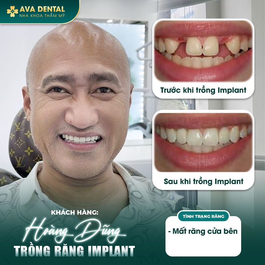 feedback implant 1