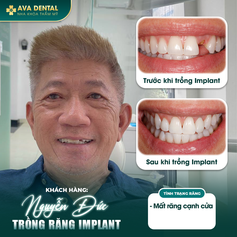 feedback implant 2