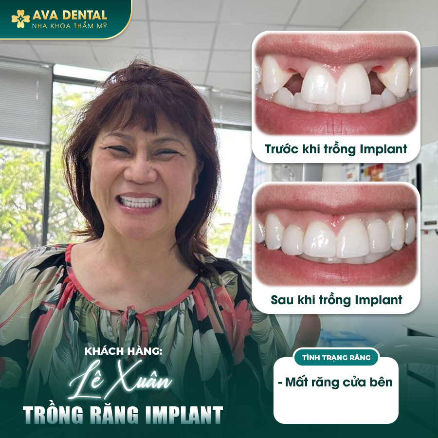 feedback implant 3