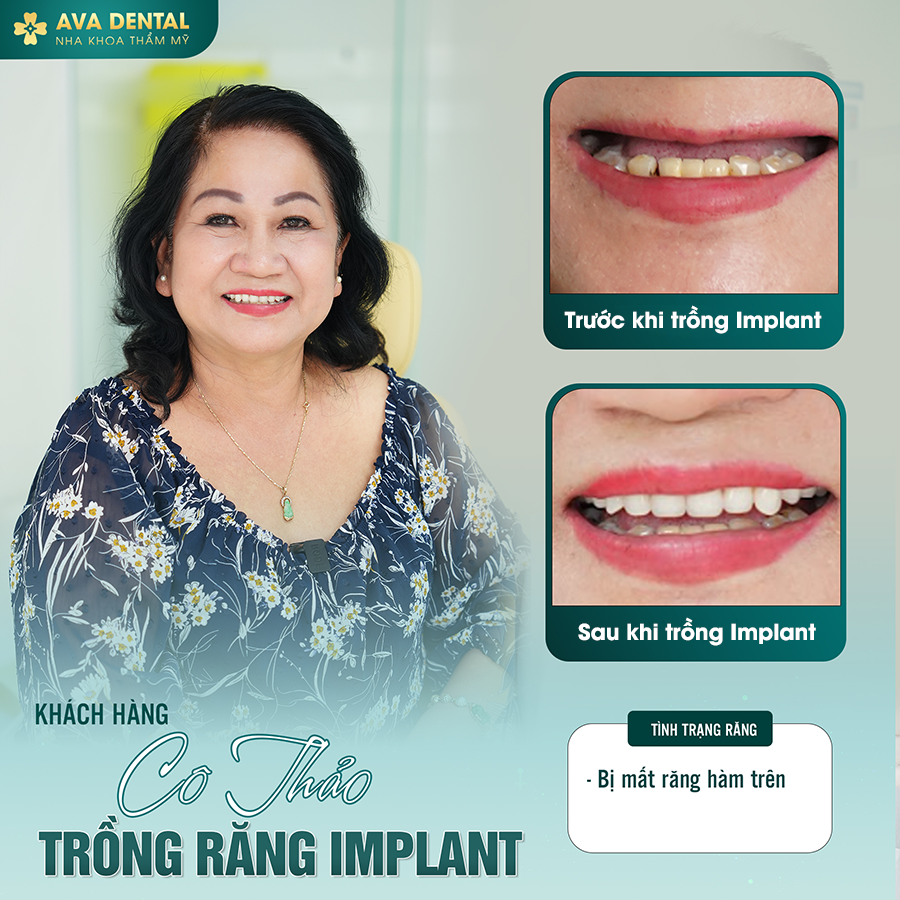 feedback implant 5
