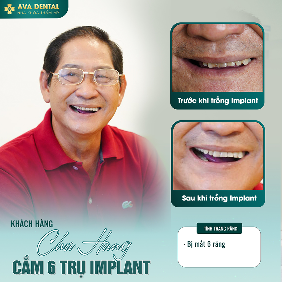feedback implant 6