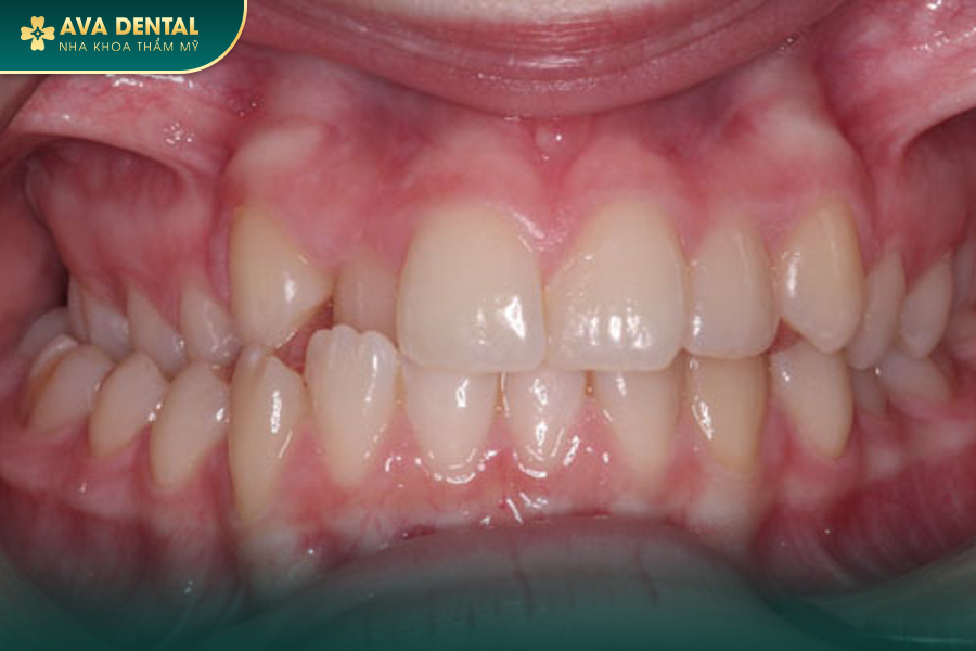 Khớp Cắn Chéo Là Gì? Chi Phí Niềng Răng Khớp Cắn Chéo Mới Nhất 2024 19 khop can cheo sau