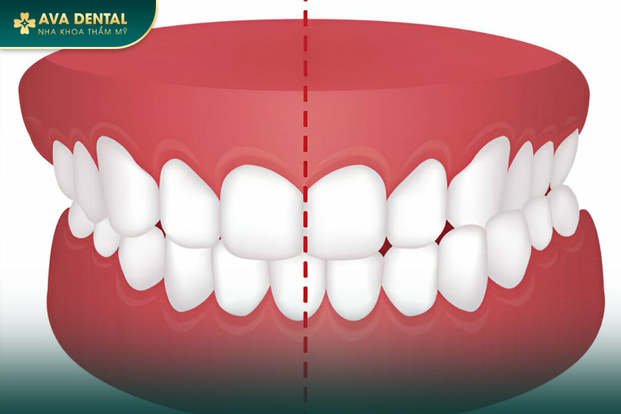Khớp Cắn Chéo Là Gì? Chi Phí Niềng Răng Khớp Cắn Chéo Mới Nhất 2024 16 khop can cheo
