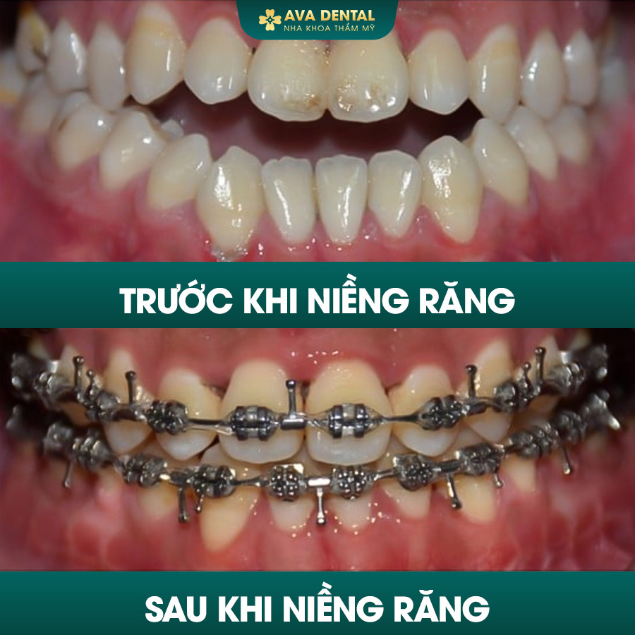 Khớp Cắn Hở Là Gì? Chi Phí Niềng Răng Khớp Cắn Hở Giá Tốt Tại TP.HCM 12 khop can ho