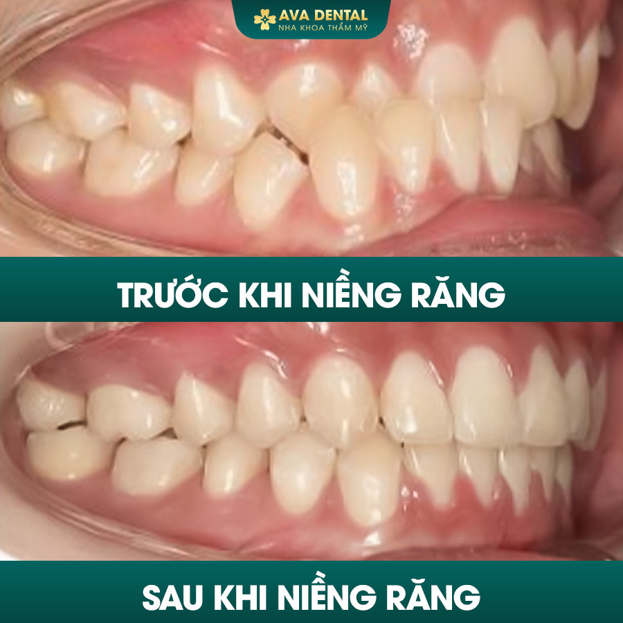 Khớp Cắn Ngược Là Gì? Chi Phí Niềng Răng Khớp Cắn Ngược Giá Tốt 13 khop can nguoc