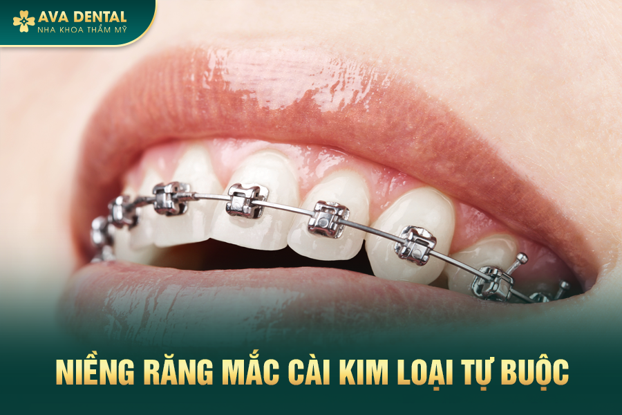 Mắc Cài Kim Loại Tự Buộc Là Gì? Chi Phí Niềng Răng Mắc Cài Tự Buộc Giá Tốt TP.HCM 17 mac cai kim loai tu buoc