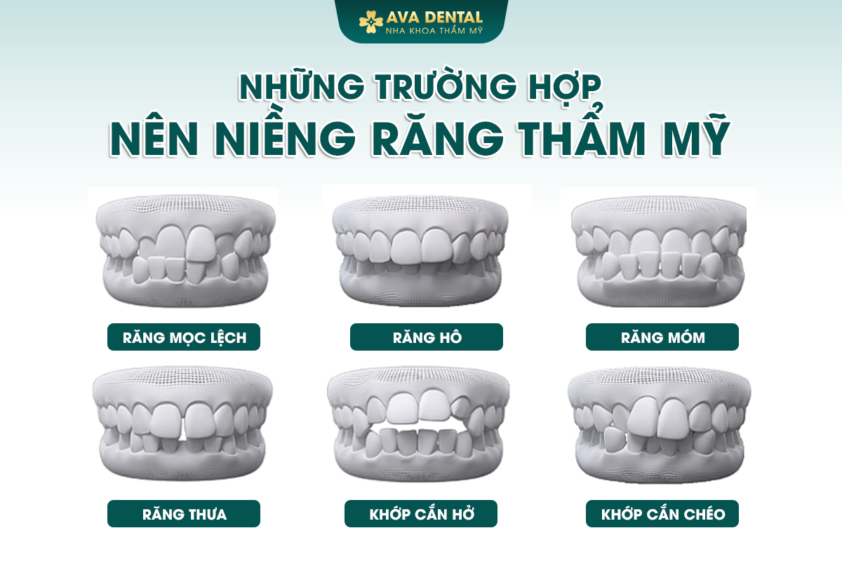 Niềng Răng Là Gì? Độ Tuổi Niềng Răng Bao Nhiêu Là Hợp Lý? 14 nhung truong hop nieng rang