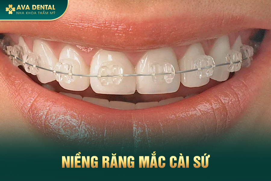 Niềng Răng Là Gì? Chi Phí Niềng Răng Mới Nhất 2024 19 nieng mac cai su