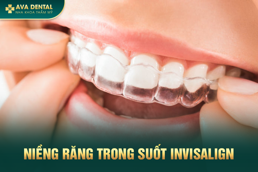 Niềng Răng Là Gì? Chi Phí Niềng Răng Mới Nhất 2024 20 nieng mac trong suot