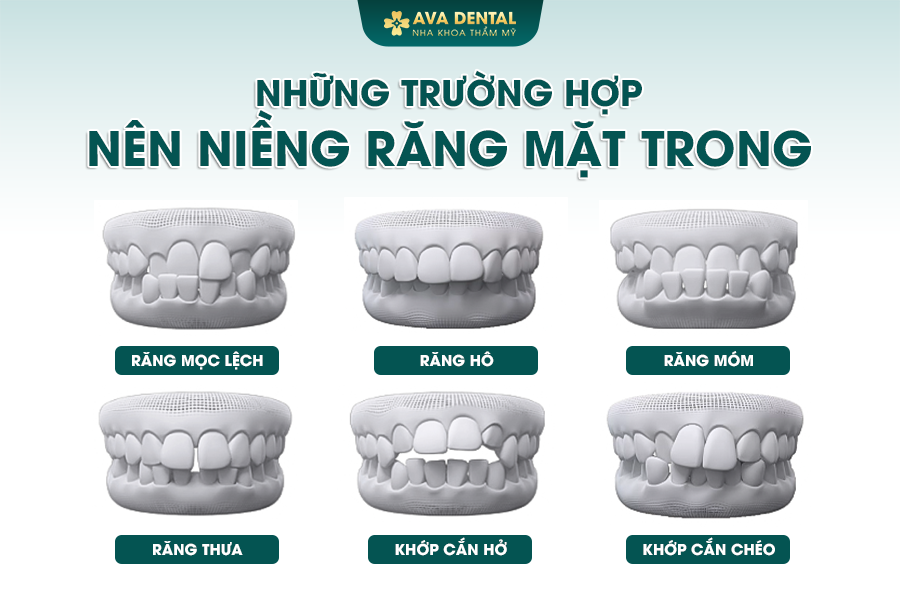 Niềng Răng Mặt Trong (Mặt Lưỡi) Là Gì? Chi Phí Bao Nhiêu 2024? 15 nieng rang mat trong 1