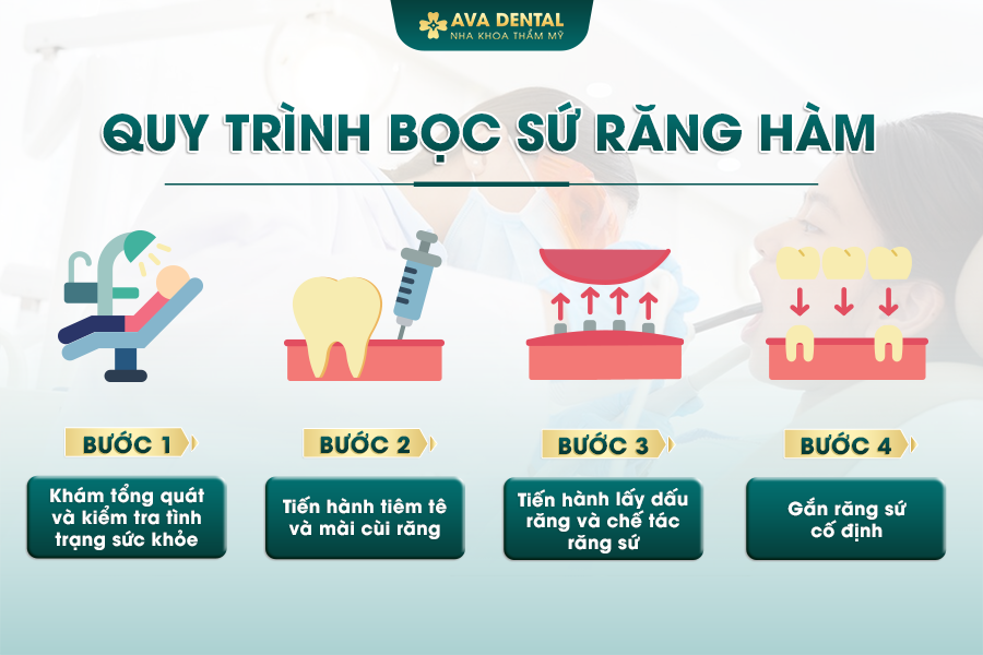 Bọc Răng Sứ Cho Răng Hàm Là Gì? Chi Phí Bao Nhiêu 2024 23 quy trinh boc su rang ham